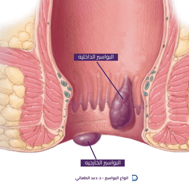 البواسير الخارجية وطرق علاجها مع الدكتورة دعد الطعاني