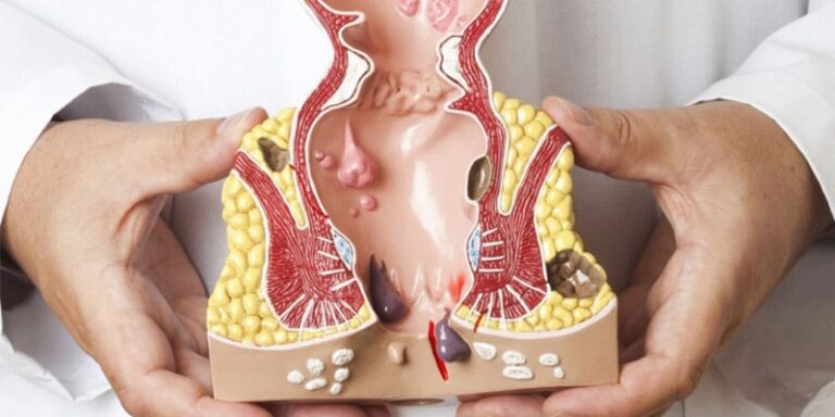 الشق الشرجي د دعد الطعاني