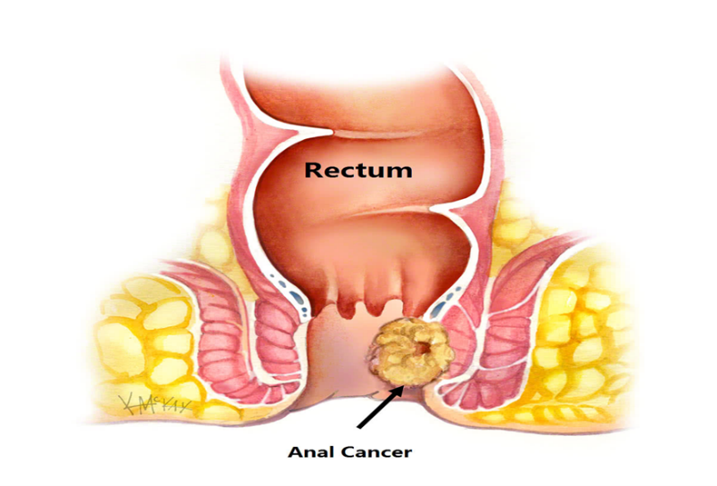 Anal Cancer