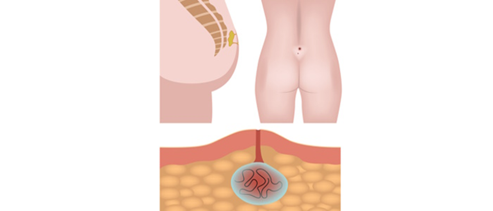 Pilonidal sinus