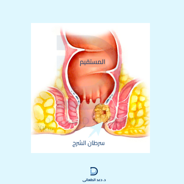 سرطان الشرج