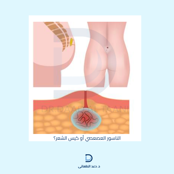 الناسور العصعصي