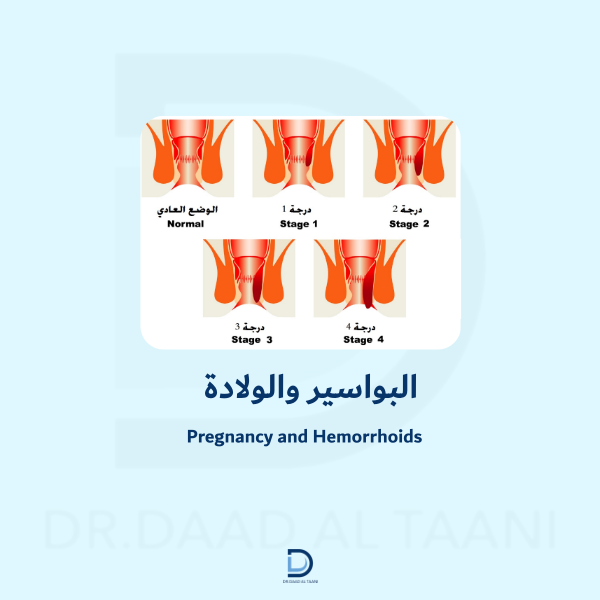 البواسير والولادة
