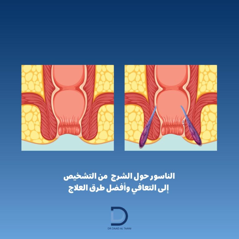 الناسور حول الشرج