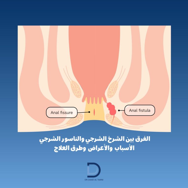 الفرق بين الشرخ الشرجي والناسور الشرجي الأسباب والأعراض وطرق العلاج شرح الدكتورة دعد الطعاني