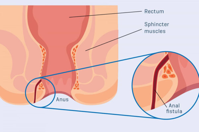 Anal fistula
