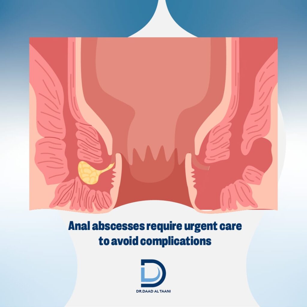 Anal abscesses require urgent care to avoid complications