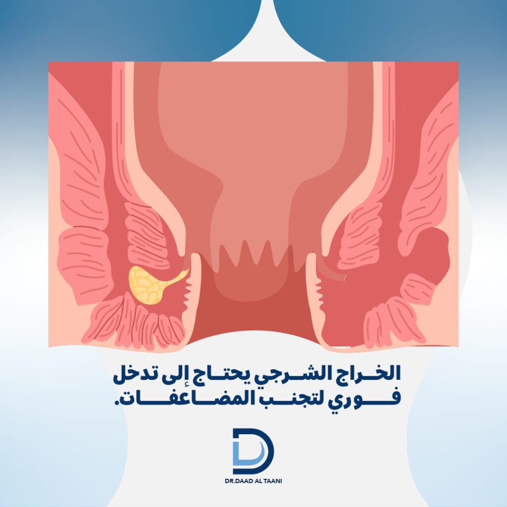 الخراج الشرجي يحتاج الى تدخل فوري لتجنب المضاعفات