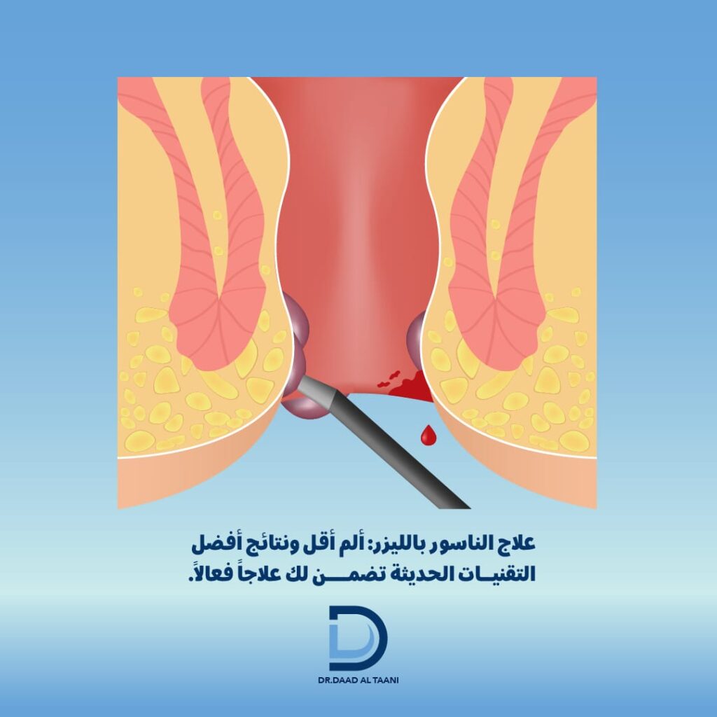 علاج الناسور بالليزر