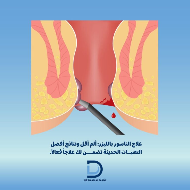 علاج الناسور بالليزر