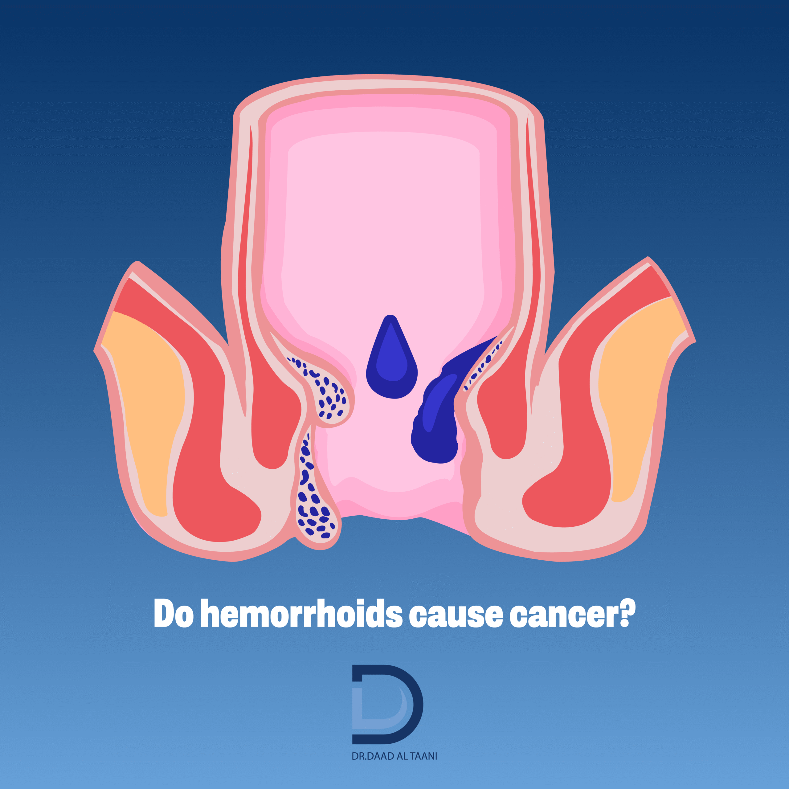 Do hemorrhoids cause cancer?