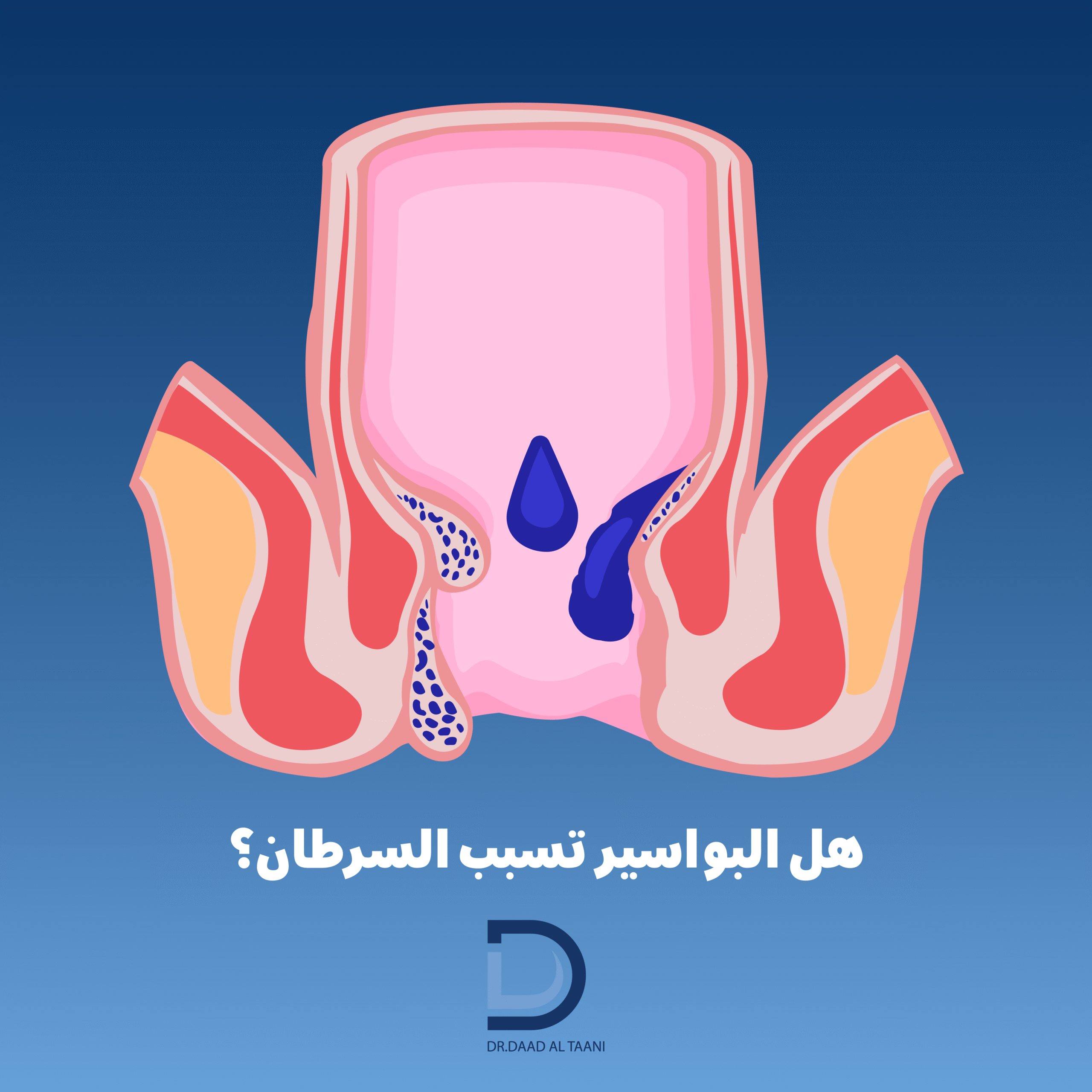 هل البواسير تسبب السرطان؟ مع عيادة د. دعد الطعاني افضل طبية بواسير فى الامارات